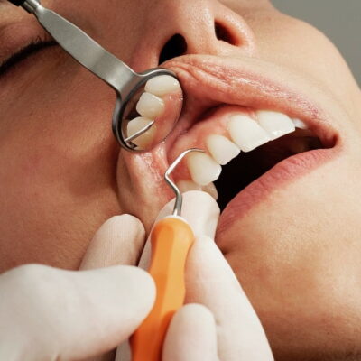 Dental Teeth Cleaning in Barrie