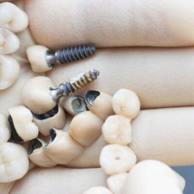 Dental Work And Metal Allergies