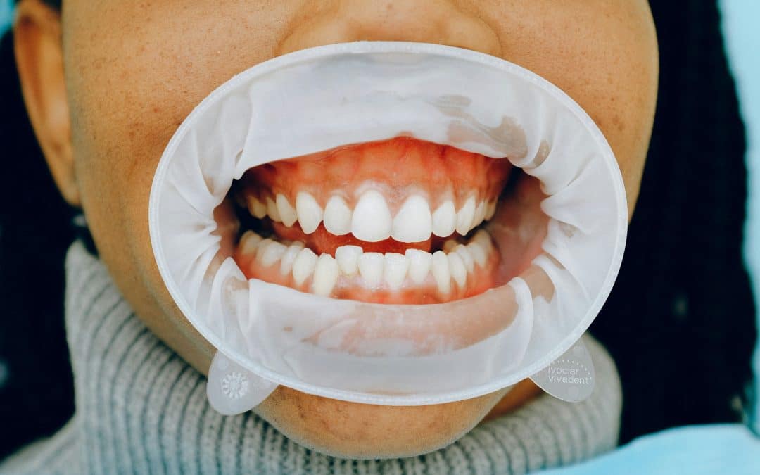 What is Fluorosis