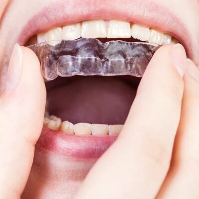 Benefits of Mouth Guards
